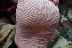 抗洪战士的脚让网民大呼心疼，有没有什么办法可以预防？图片