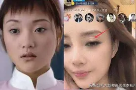 拆线后发现双眼皮不对称怎么办？这是什么原因呢？图片