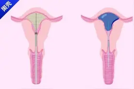 有能让女性免受月经、怀孕之苦的手术？为啥还没推广呢？图片