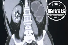 6旬老人术后一个疏忽，硬生生把自己的半边肾弄“丢”了图片