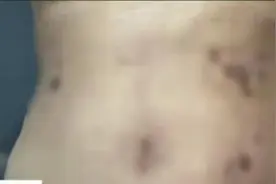 体重100斤美女做抽脂手术，哭诉：我老公都不敢碰我的肚子图片