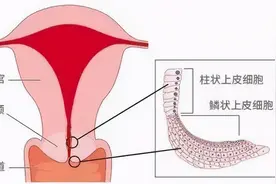 TCT、阴道镜、CIN、锥切（leep）都是什么意思？图片