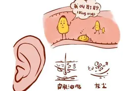 耳屎究竟是咋形成的？为啥有的人耳屎干干的有人油油的？图片