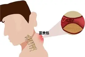 不可轻视的“富贵包”图片