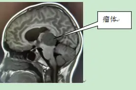 9岁男孩松果体长肿瘤 江西省儿童医院为其进行微创手术图片