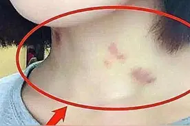 13岁女生脖子被种“草莓”，真相让妈妈落泪：都是妈妈的错图片