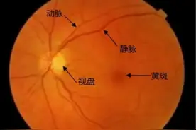 眼底检查系列：大视杯、生理凹陷扩大，怀疑青光眼，怎么办？图片