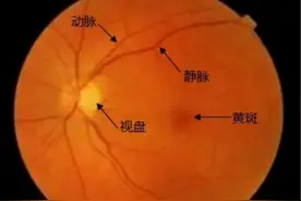 眼底检查系列：大视杯、生理凹陷扩大，怀疑青光眼，怎么办？图片