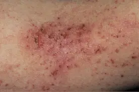 湿疹怎么治疗图片