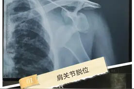 摔了一跤，肩关节脱位了怎么办？图片