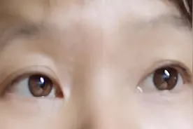 去除汗管瘤，下决心要激光图片