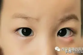 #健康科普汇#  【医学探秘】看了才知道，宝宝为什么反复患霰粒肿？图片