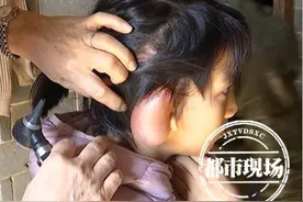 9岁女孩右耳残疾孤僻自卑 抱养家庭倾其所有：哪怕苦点也要治图片
