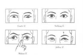 甲亢突眼的诊断标准图片