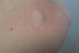皮下长了脂肪瘤，需要切掉吗？图片