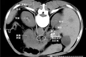 癌性腹痛，“打一针”能管好几个月不疼？是真的图片
