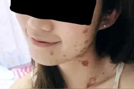 又一女星险毁容！因煎香肠致二级烧伤，白嫩脸颊满是水泡超明显图片