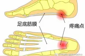 晨起足跟痛的自我调理图片
