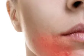 疤痕应该怎么护理？图片