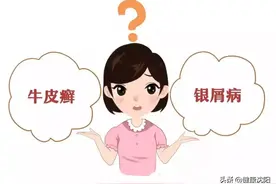 健康科普堂 | 春季银屑病高发，做好预防很重要！图片