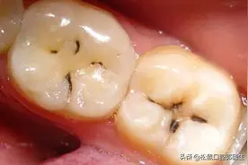 补了牙齿多久会掉？图片