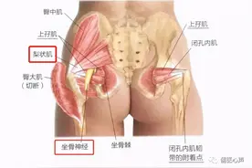 防火防盗防闺蜜，得了坐骨神经痛，也许是中了闺蜜的温柔陷阱图片