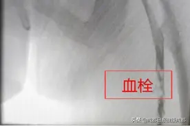 返校大学生连坐10小时腿肿如大象 医生称“经济舱综合征”可致死亡图片