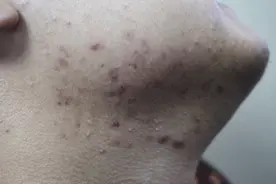 一熬夜，脸上就起疙瘩，“痘痘体质”该怎么办？皮肤科医生支招图片