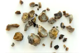 肾结石到底能否自己排出去？帮助排出结石的4种方法，你了解了吗图片