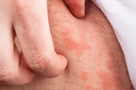 不要错把艾滋病当皮肤病，皮肤出现3种情况，可能是艾滋发出信号图片