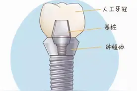 「牙齿那些事儿」No.67丨牙齿也能“种”出来？这有份种植牙攻略图片