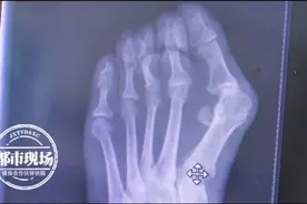 女子脚趾畸形30年不在意，最后痛到无法走路，爱穿高跟鞋的要注意图片