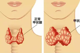 甲状腺结节的克星，这3类蔬菜常吃，甲状腺结节会慢慢变小图片