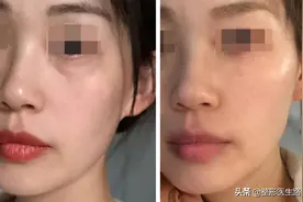“玻尿酸填泪沟”是大热项目，简单快速，为什么我不建议大家做？图片