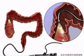 肠癌来临前，会先经历3个症状！发现一个，建议及早就医检查图片