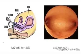 【齐鲁小科普】什么是宫腔镜检查？图片