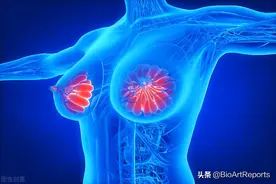 女性最常见的癌症，乳腺癌为什么容易转移？图片
