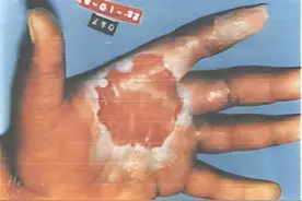 1987年巴西，两个蠢贼在废弃医院偷走一金属物，竟造成核辐射灾难图片