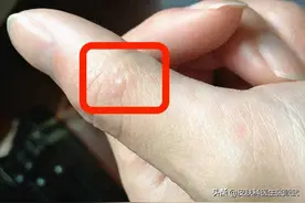 脚上手上起小水泡，小心是汗疱疹图片