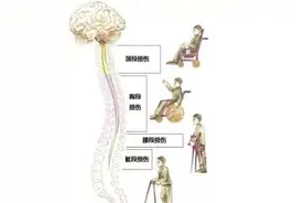脊髓损伤的患者到底可不可以过性生活？图片
