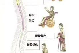 脊髓损伤的患者到底可不可以过性生活？图片