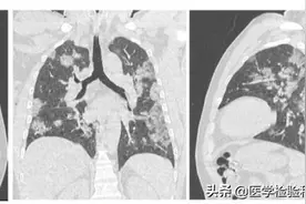 详解新型冠状病毒感染诊断全流程，在家生病不敢去医院的看过来图片