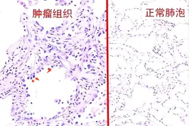 不爱吃饭，一个月瘦了6斤，原来肺癌偷偷来潜伏了视频封面