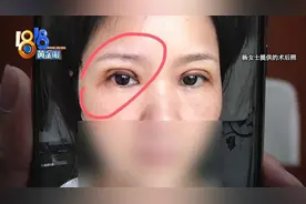 双眼皮手术以后，左眼成了“三角形”？图片
