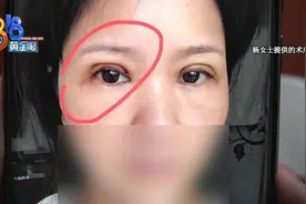 双眼皮手术以后，左眼成了“三角形”？图片