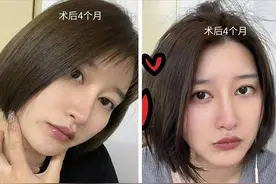 隆鼻1年后，嗅觉减退，闻啥都不香了！是怎么回事？图片