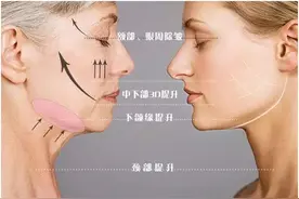线雕面部提升抗衰治疗后多久能恢复自然？| 北大教授张宗学图片