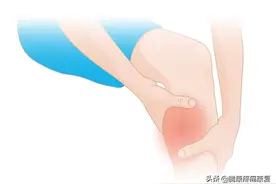 小腿疼痛——胫骨内侧应力综合征分析与诊疗图片