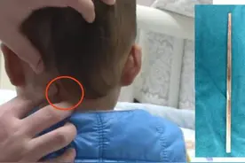 2岁幼童边吃边玩，摔倒被筷子戳穿颈部，网友：隔屏幕都觉得疼图片