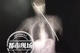 触目惊心！江西一男子被钢筋刺穿身体插进颅内，奇迹生还图片